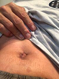 5月に虫垂炎の手術を腹腔鏡手術で受けました おへその傷が醜い Yahoo 知恵袋