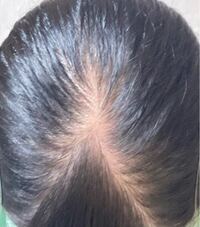 若いのに薄毛になってる女性タレントが普通にテレビ出演してるのって テレビ業界 Yahoo 知恵袋