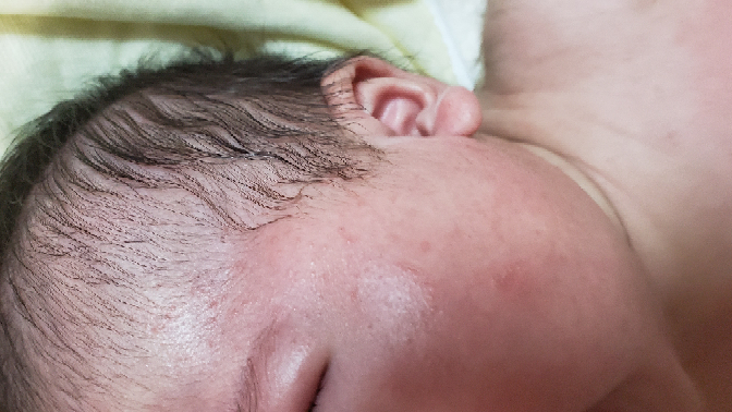 生後2ヶ月の赤ちゃんの頬や顔全体に赤みが出ましたが ニキビでしょうか Yahoo 知恵袋