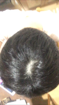 これはつむじハゲですか Yahoo 知恵袋