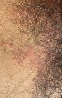 写真閲覧注意18歳女子です 2ヶ月前から陰部付近に赤みのある Yahoo 知恵袋