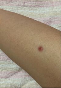 ほくろ除去後はやはり傷が完全に元通りに治ることはないのでしょうか また 鼻 Yahoo 知恵袋