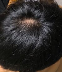 中学のとき抜毛症で抜きまくってしまい その頃に比べたらかなり Yahoo 知恵袋