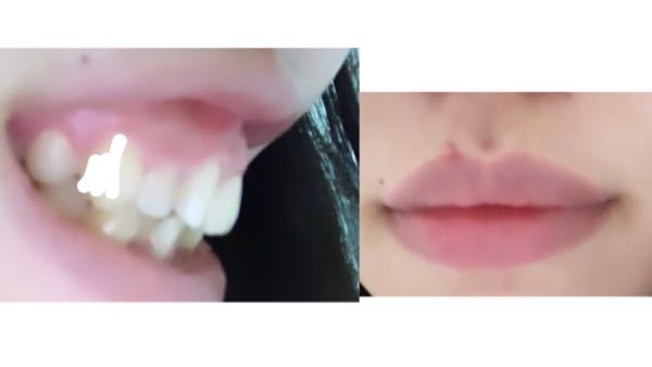 私はすごい自分の口元がコンプレックスです 唇の形も両方分厚くて歪 Yahoo 知恵袋