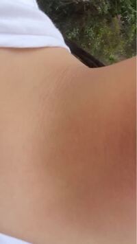 黒色表皮腫というもので小学六年生の時に黒くなってから治りませ Yahoo 知恵袋