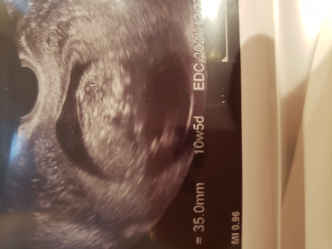 10w5dのエコー写真です 首の後ろのちょっとした空洞 Yahoo 知恵袋