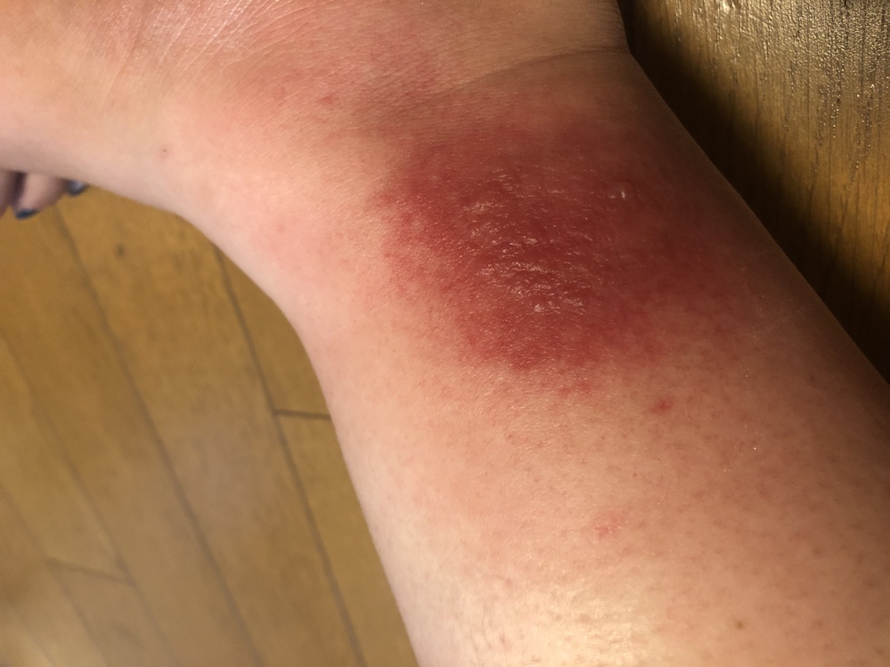 蟻に刺されました刺されてから1時間位してゲンタシン軟膏をぬり Yahoo 知恵袋