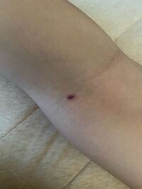 内出血でしょうか 紫の斑点についてです 気づいたら膝の Yahoo 知恵袋