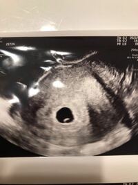 4週6日目に胎嚢6mm確認しましたが 本日6週2日には胎嚢1 Yahoo 知恵袋