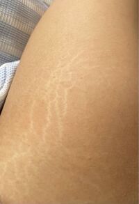 白い肉割れと赤っぽくなる肉割れの違いはなんですか 赤い肉割れは出来 Yahoo 知恵袋