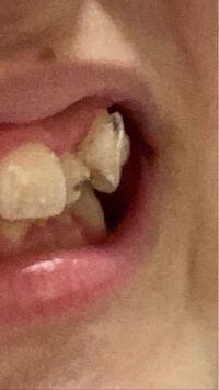 至急 歯の写真ありますインビザライン矯正についてで Yahoo 知恵袋