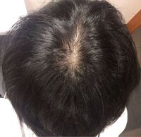 質問です これはハゲですか それともただのつむじですか Yahoo 知恵袋