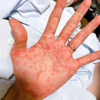 今日の朝から手に赤い斑点があり 仕事から帰宅すると足な身体に Yahoo 知恵袋