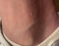 足首に白いポツポツしたものが出来ています 痛くはなく痒いです コレは何 Yahoo 知恵袋