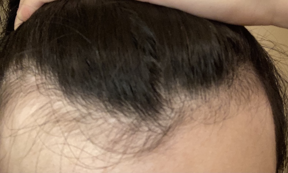 薄毛 抜け毛 すべての質問 Yahoo 知恵袋