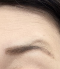 眉上の山について
眉毛をあげると上の筋肉も上がってしまい眉が２つになってしまいます。 どうやったら治りますか？また美容外科クリニック等で対処する事は可能でしょうか