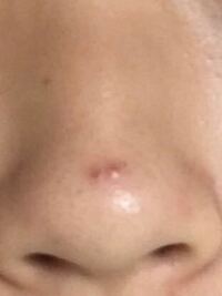 鼻のニキビ跡 の治し方を教えてください 目立たなくする方法で Yahoo 知恵袋