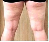 太ももの裏のセルライトがすごいのですが どうすれば治りますか 以前ダイエッ Yahoo 知恵袋