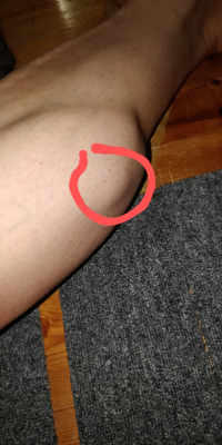 ふくらはぎのこのボコッとしてる部分は肉離れですか 痛みはちょっと Yahoo 知恵袋