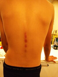 息子 中学2年生男子170センチ体重47kg痩せがた の背骨に沿って内 Yahoo 知恵袋