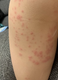 子供がうんちを漏らしてしまい 翌日お尻から太ももにかけて写真 Yahoo 知恵袋