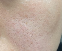 顔の毛穴をなくす方法教えてください 毛穴の悩み 何をど Yahoo 知恵袋