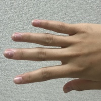 人差し指 薬指 小指が写真のように昔から曲がっているのですが病気か何か Yahoo 知恵袋