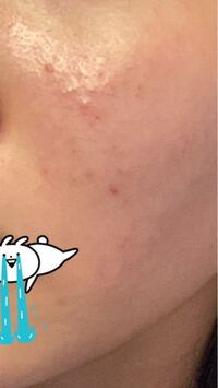 閲覧注意です 中3 女子です 最近 肌荒れが酷いです 日焼け止め Yahoo 知恵袋