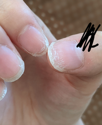 最近爪が急にこんな感じになってしまったのですが原因とか対処法 Yahoo 知恵袋