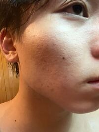 ニキビ跡のクレーターについての質問です 長年クレーター Yahoo 知恵袋