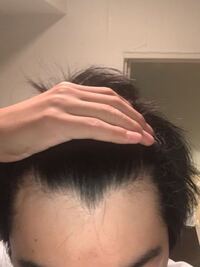 ハゲがなおるってすごくないですか 職場の上司なんですが 前は完全にハゲかけてい Yahoo 知恵袋