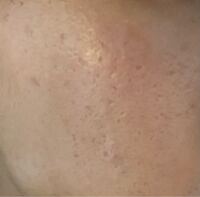 男性です このような肌の汚れはニキビ跡でしょうか また 毛穴が開 Yahoo 知恵袋