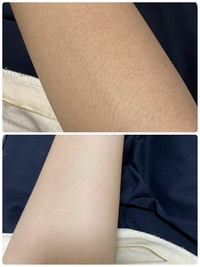 日焼け痕が悩みです 腕の表面が 上の画像のようにぶつぶつの茶色い日焼け Yahoo 知恵袋