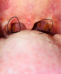 至急 閲覧注意 この写真の のところのブツブツなんですか 汚く Yahoo 知恵袋