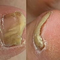 グロい患部 足爪あり 閲覧注意 妊娠中フットケアがで Yahoo 知恵袋