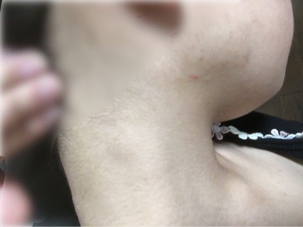 首にしこりのようなものが出来ました。 - 大きいものから小さいもの 