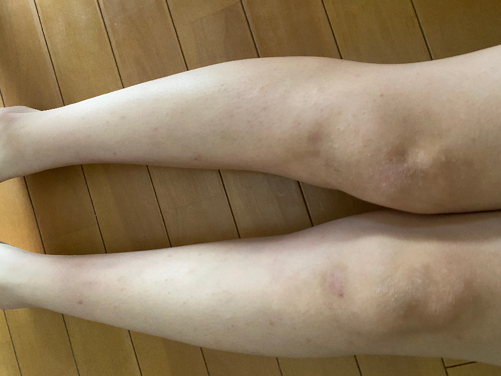 アトピーで引っ掻いた跡がふくらはぎや太ももに色素沈着してしまってるんで Yahoo 知恵袋