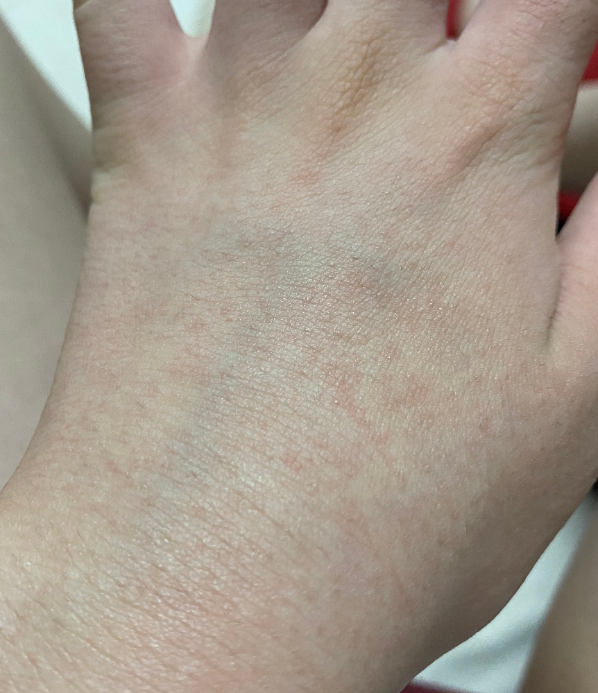 皮膚の病気 アトピー 回答受付中の質問 Yahoo 知恵袋