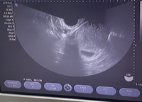 27歳繋留流産経験してます 現在妊娠6w0dで胎嚢mmまで成 Yahoo 知恵袋