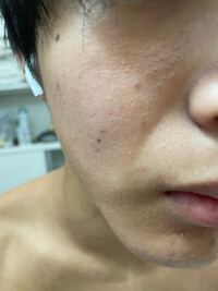 中三男子です 毎日洗顔をしているのですが 写真のように肌が汚いで Yahoo 知恵袋