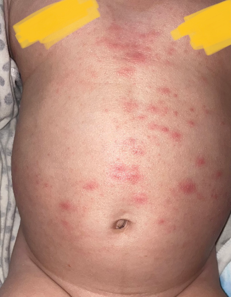 皮膚の病気 アトピー 解決済みの質問 Yahoo 知恵袋