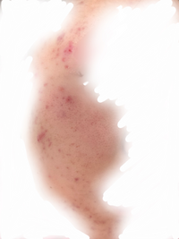 高校2年女です ニキビが酷すぎて死にたいです 1年以上皮膚科に通ってい Yahoo 知恵袋