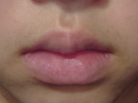 唇が厚いのを薄くする方法教えてください たらこ唇の直し方には 呼吸法の Yahoo 知恵袋