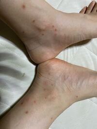 足首にのみブツブツができています とても痒いです 虫刺されなのでし Yahoo 知恵袋