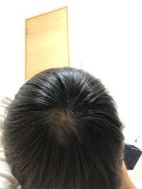 最近ストレスで髪の毛を抜いてしまいます これは禿げてますか 男子高校生 Yahoo 知恵袋