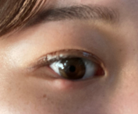 突然涙袋に謎の腫れができました1時間前までなかったのですがな Yahoo 知恵袋