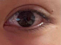 眼瞼下垂の手術を7年ほど前に行いましたが 二重幅を広くしてし Yahoo 知恵袋