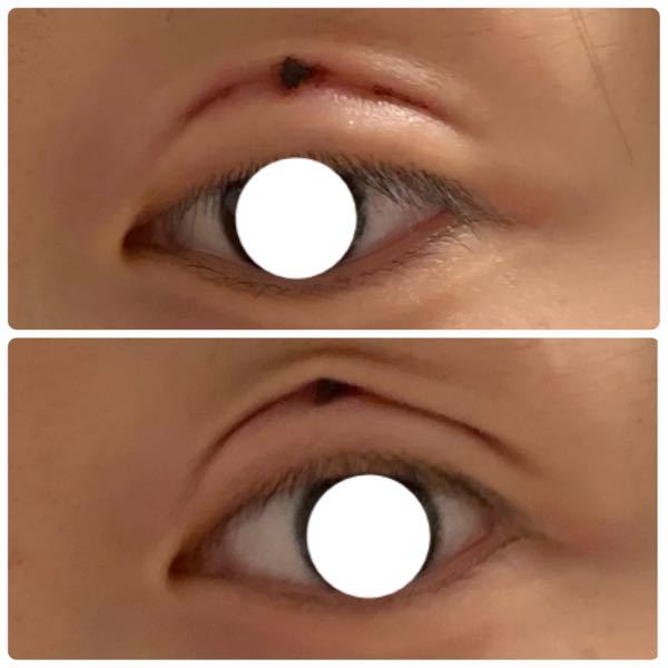 今日二重埋没してきたのですがかさぶた みたいなのがまぶたにできちゃ Yahoo 知恵袋