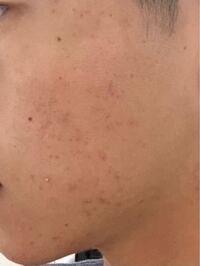 肌荒れがすごいです 写真よりも生の方が汚いです どうすれば治りますか Yahoo 知恵袋