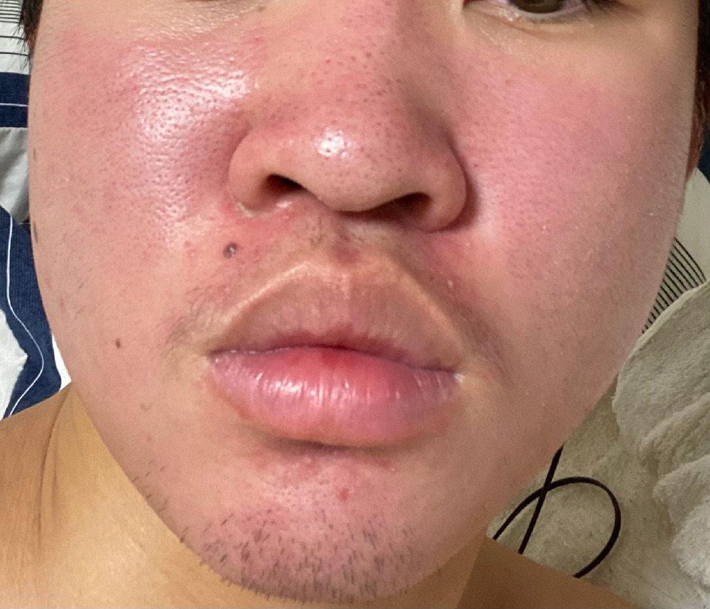 これは脂漏性皮膚炎なのでしょうか。 - 自分は高校生男子です 